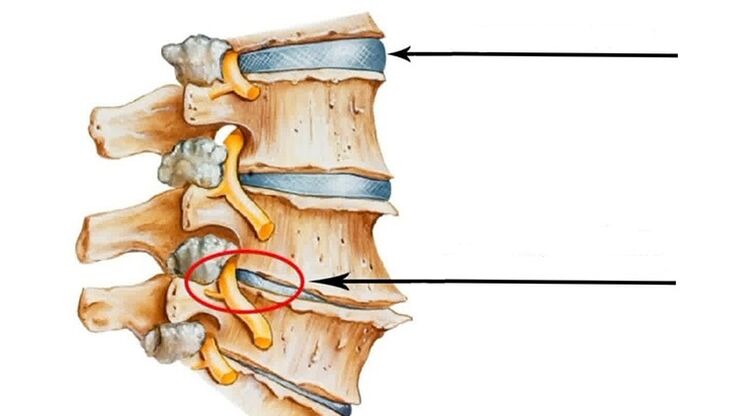Τραυματισμός της σπονδυλικής στήλης στην αυχενική οστεοχονδρωσία