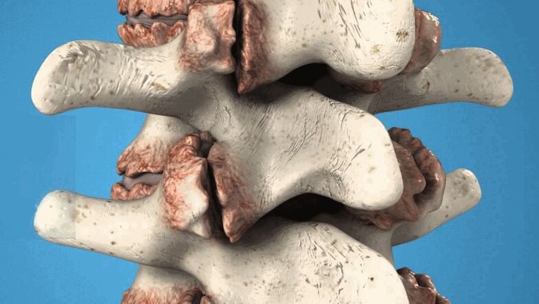Τα οστεόφυτα της σπονδυλικής στήλης ως αιτία πόνου στην πλάτη