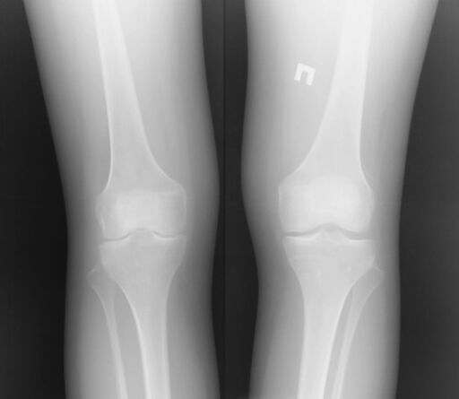 Η εικόνα x -ray της άρθρωσης του γόνατος