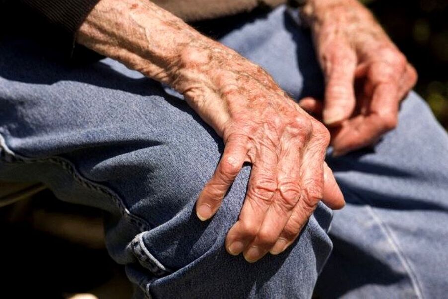 Η οστεοαρθρίτιδα είναι μια ασθένεια που σχετίζεται με την ηλικία και εμφανίζεται σε άτομα μεγαλύτερης ηλικίας
